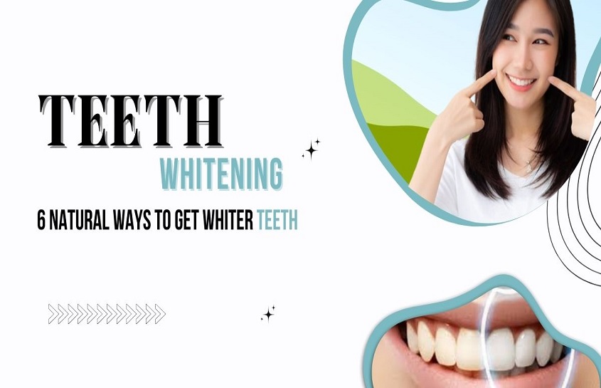 Teeth Whitening: 6 Natural Ways to Get Whiter Teeth