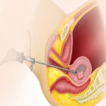 Hysteroscopy Treatment